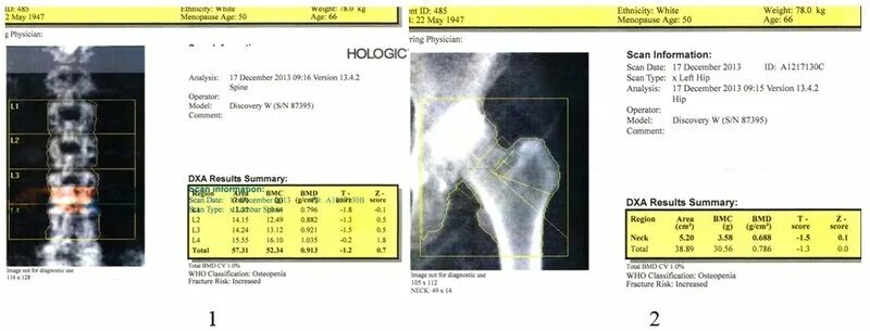 Денситометрия тазобедренных суставов и поясничного отдела позвоночника. Остеоденситометрия остеопороз. Остеоденситометрия рентген расшифровка. Денситометрия при остеопорозе. Норма денситометрии позвоночника.
