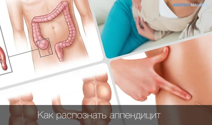 Что делает аппендикс. Воспаление аппендицита. Как определить аппендеци. Как определить аппендицит.