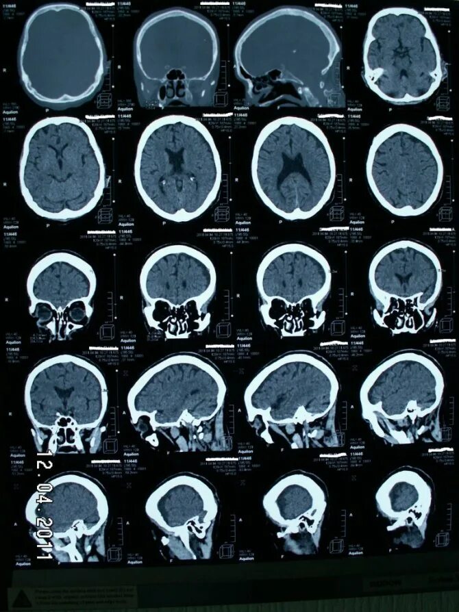 Кт головы стоя. Кт томограмма головного мозга. Субдуральная гигрома головного. Субдуральная гигрома снимок кт головного мозга. Головной мозг на кт-томографии.