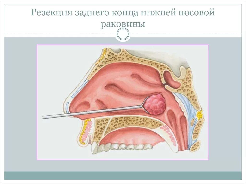 Задний насморк