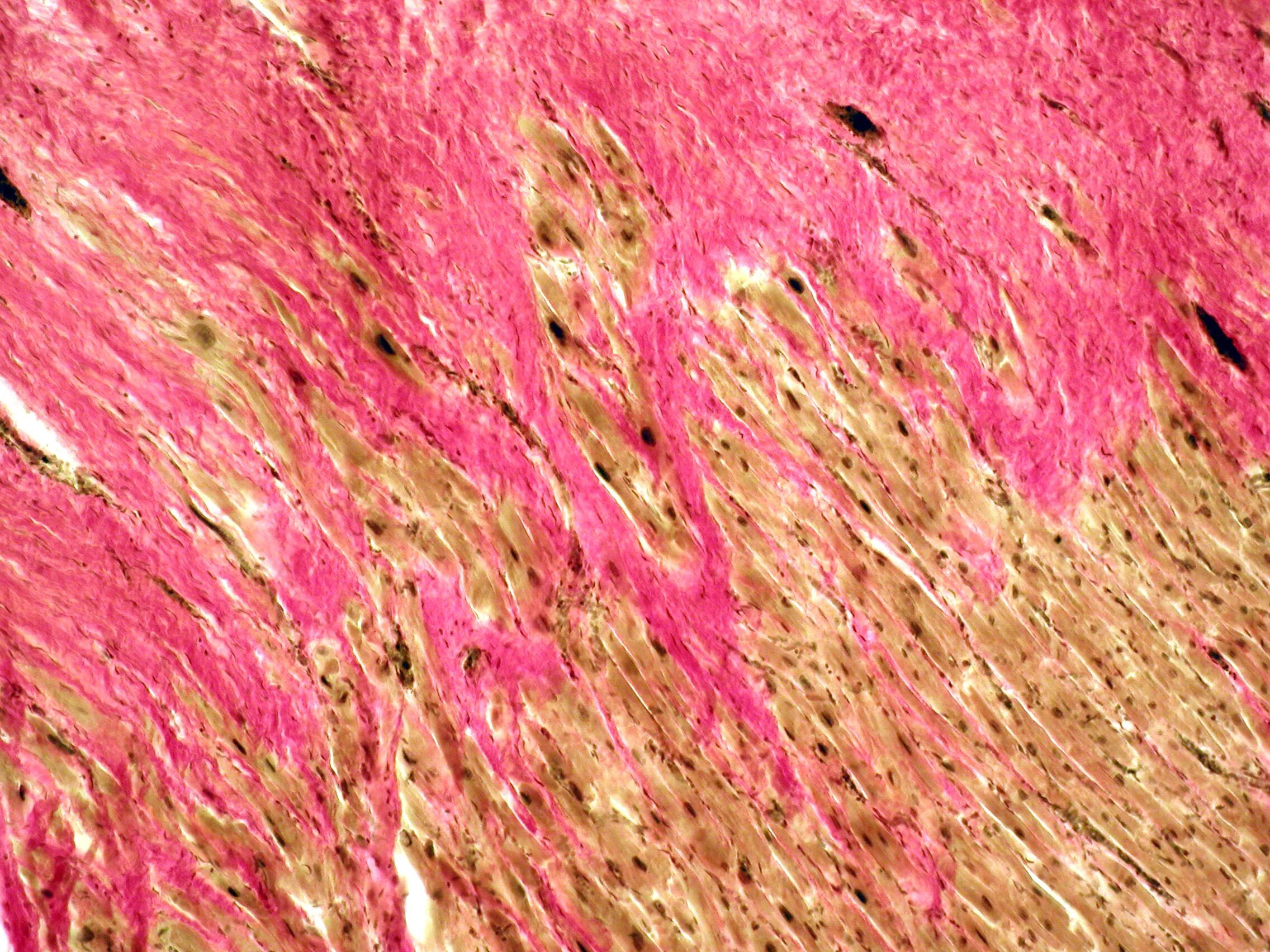 Диффузный мелкоочаговый. Пикрофуксином по Ван Гизону. Крупноочаговый постинфарктный кардиосклероз макропрепарат. Кардиосклероз пикрофуксин. Кардиосклероз Ван Гизон.