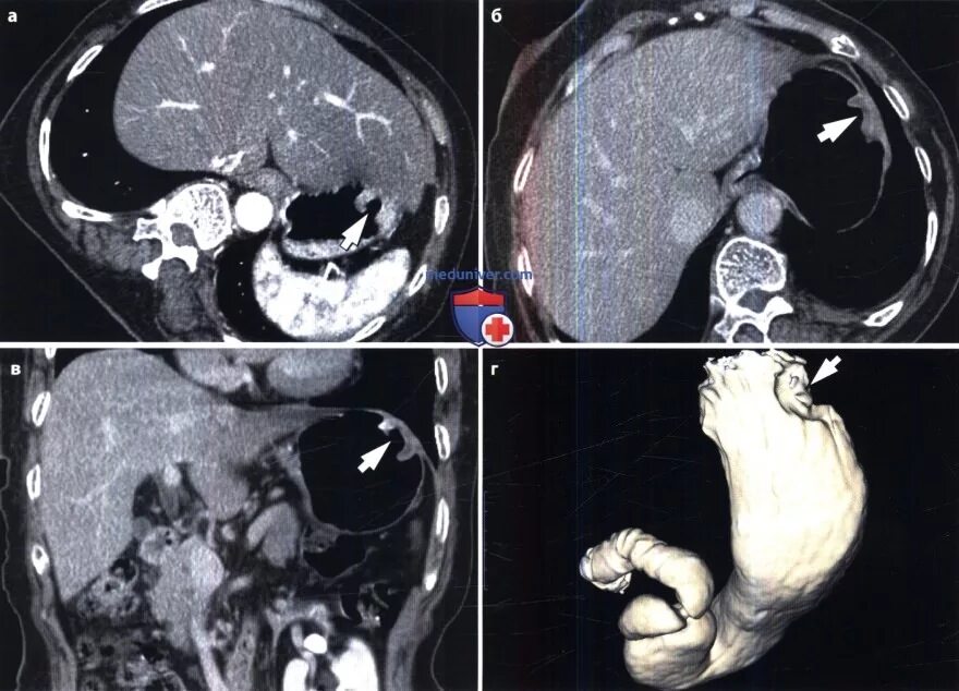 Новообразование желудка на кт. Онкология желудка 4 стадия