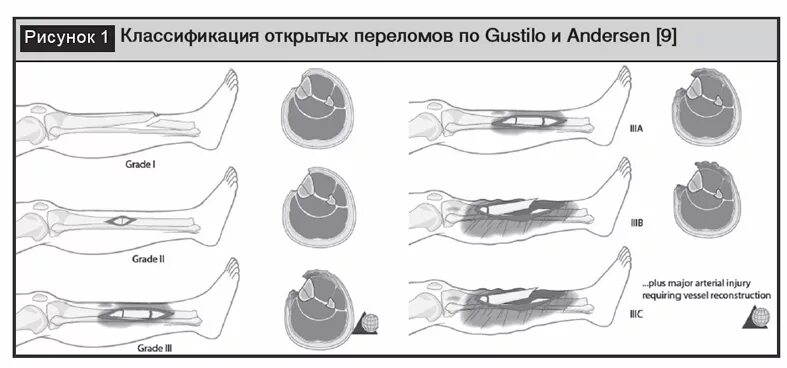 Степени открытого перелома. Классификация открытых переломов Gustilo-Anderson. Классификация открытых переломов (Gustilo-Anderson, 1976). Классификация переломов по Густило Андерсен. Открытый перелом классификация по Густило.