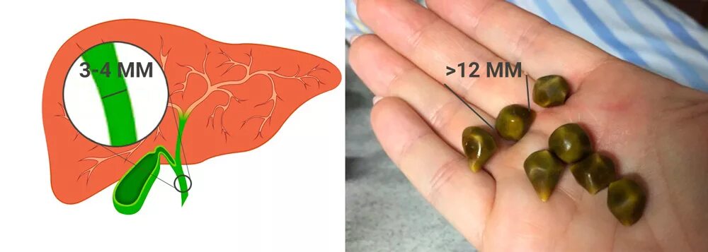 Камни в протоке печени. Тюбаж желчного пузыря камни. Прочищение протоков желчного пузыря. Чистка протоков желчного пузыря..
