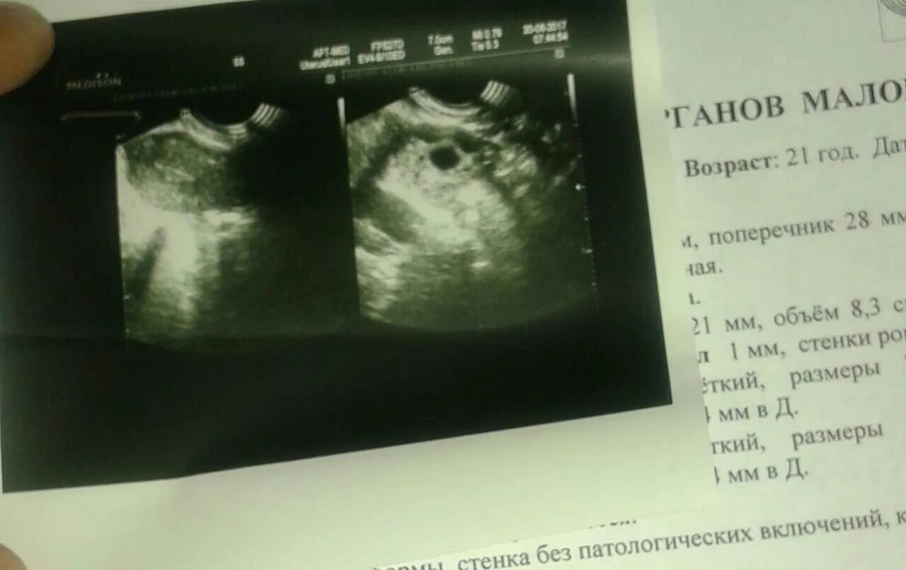 Белое пятно на узи. На узи малого таза темное пятно. темное пятно в матке на узи что это.