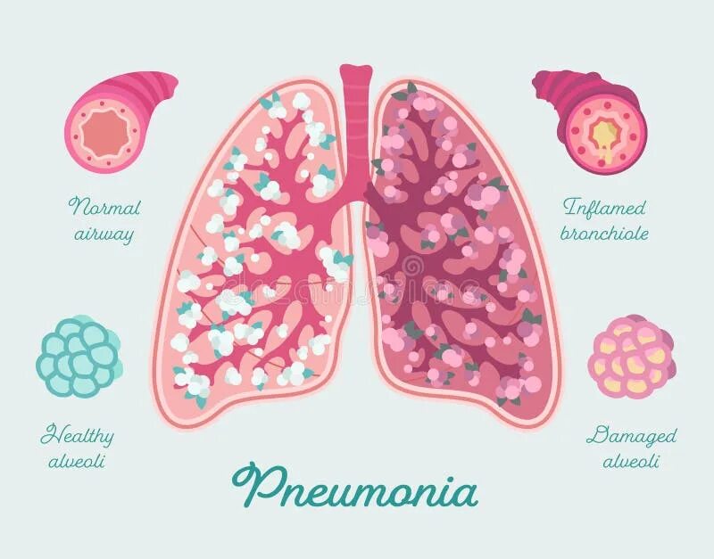 Pneumonia respiratory rate. Pneumonia respiratory rate. Пневмония инфографика. Легкие альвеолы. Пневмония легочных альвеол.