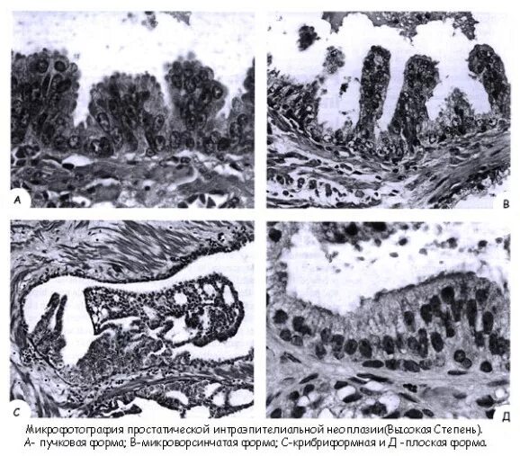 Плоское интраэпителиальное поражение низкой степени. Интраэпителиальная неоплазия предстательной железы. Простатическая интраэпителиальная неоплазия гистология. Неоплазия высокой степени. Пин простаты гистология.