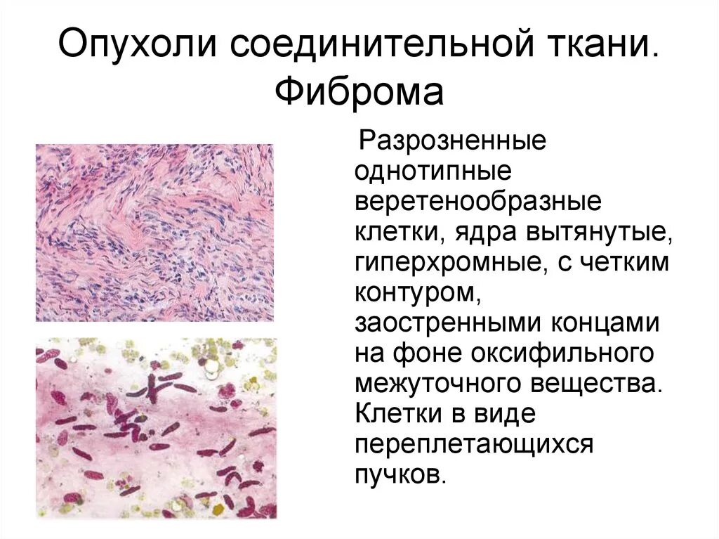 Опухоли из соединительной ткани патанатомия. Фиброма соединительной ткани. Виды доброкачественных опухолей соединительной ткани. Опухоли волокнистой соединительной ткани. Злокачественная опухоль из соединительной