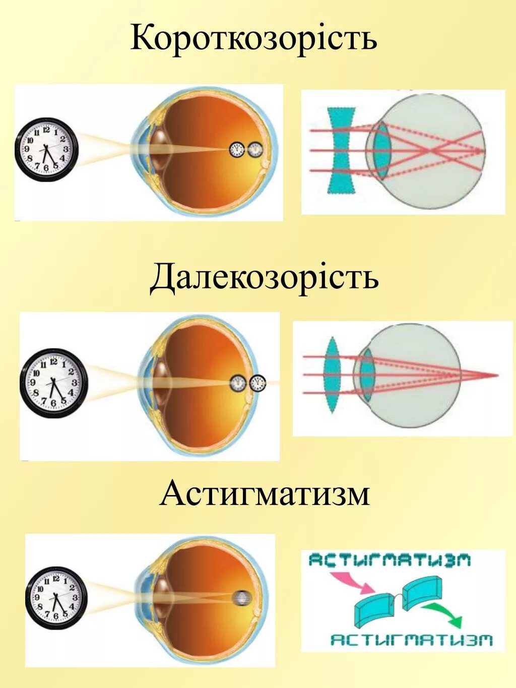 Глаз очки дальнозоркость и близорукость. Близорукость. Зрение близорукость. Зрение при близорукости. Близорукий астигматизм.