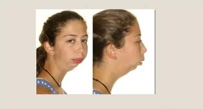 Как выглядит аденоидное лицо Adenoids. To cure or remove Adenoids are the pharyngeal amygdala, which is part
