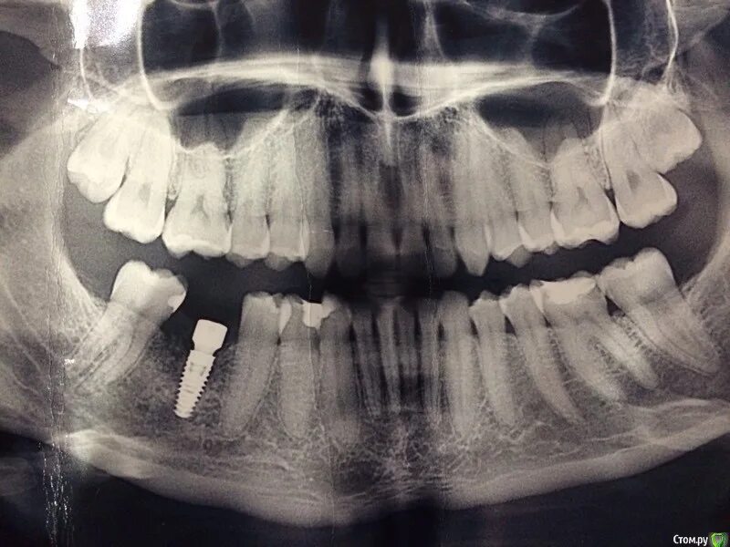 Снимок зубов видное. Ортопантомограмма кариес.