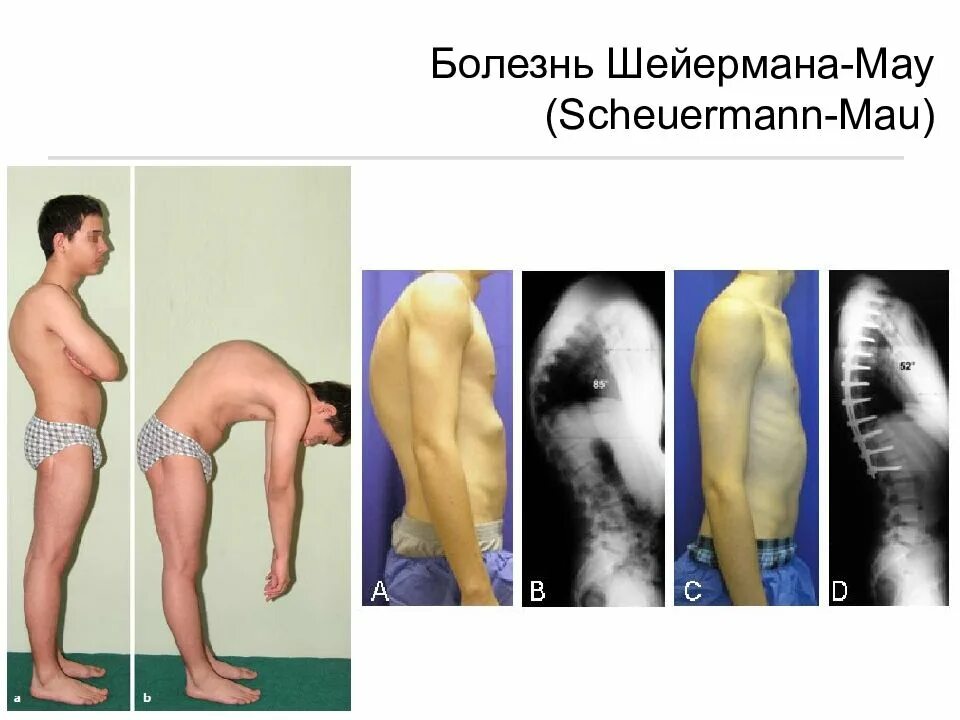 Кифоз грудного отдела степени. Кифоз болезнь шейермана-мау. кифоз при болезни шейермана мау. кифоз грудного отдела болезнь шейермана мау.