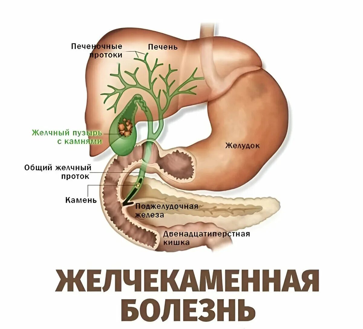 Как восстановить печень и поджелудочную. Анатомия ЖКТ желчный пузырь. Желчный пузырь и желчные протоки анатомия. Камни поджелудочной железы ЖКБ. Желчекаменная болезнь анатомия.