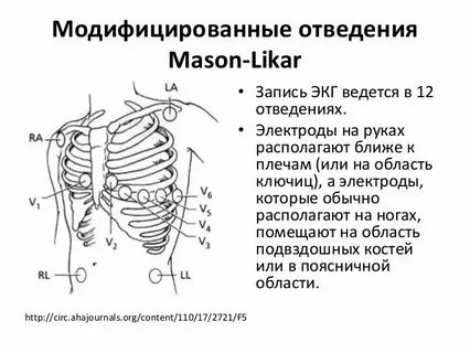 Наложение электродов при экг схема по цветам