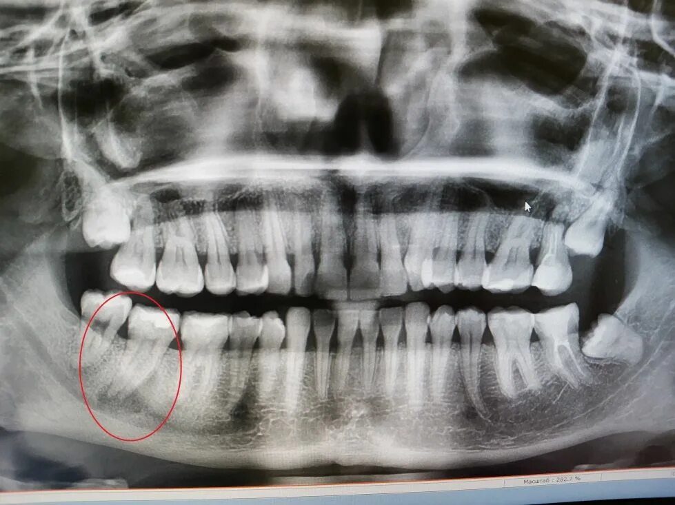 Снимок зубов видное. ОПТГ зубных рядов Пикассо. Рентген ОПТГ зубных рядов. ОПТГ Кеннеди.