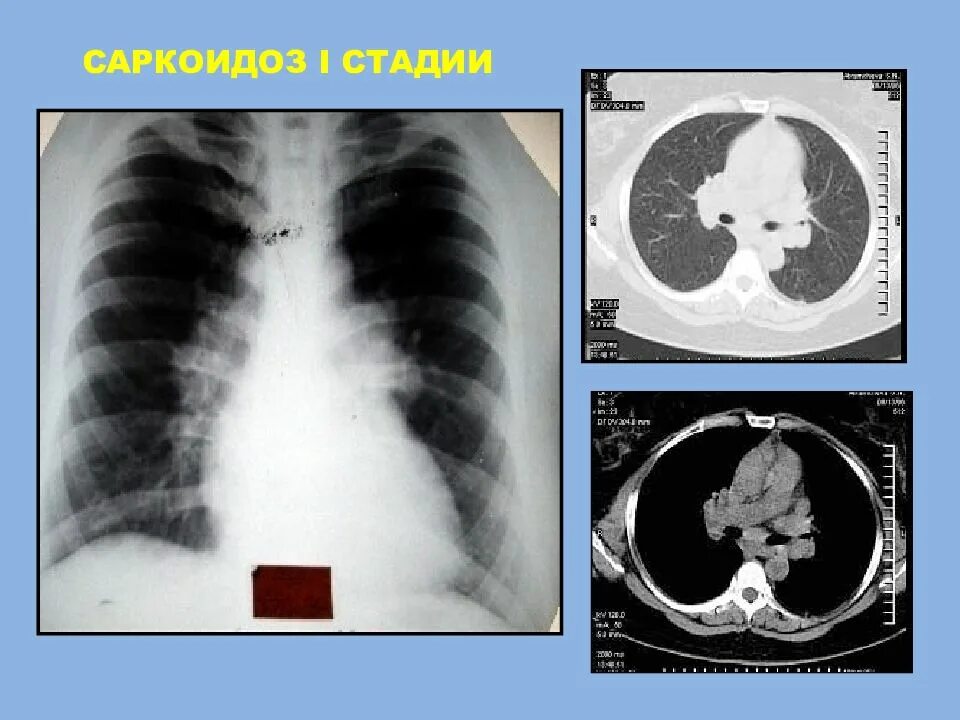 Лечение лимфоузла легкого. Саркоидоз 2 стадии рентген. Саркоидоз внутригрудных лимфатических узлов рентген. Медиастинально-легочный саркоидоз. Саркоидоз внутригрудных лимфоузлов рентген.