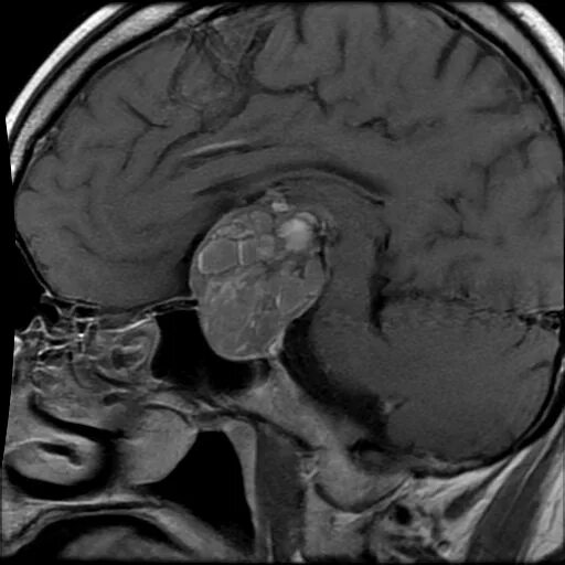 Опухоль гипофиза. Соматотропная аденома гипофиза. Эндоселлярная аденома гипофиза. Опухоль гипофиза на мрт. Эндоселлярная микроаденома гипофиза.