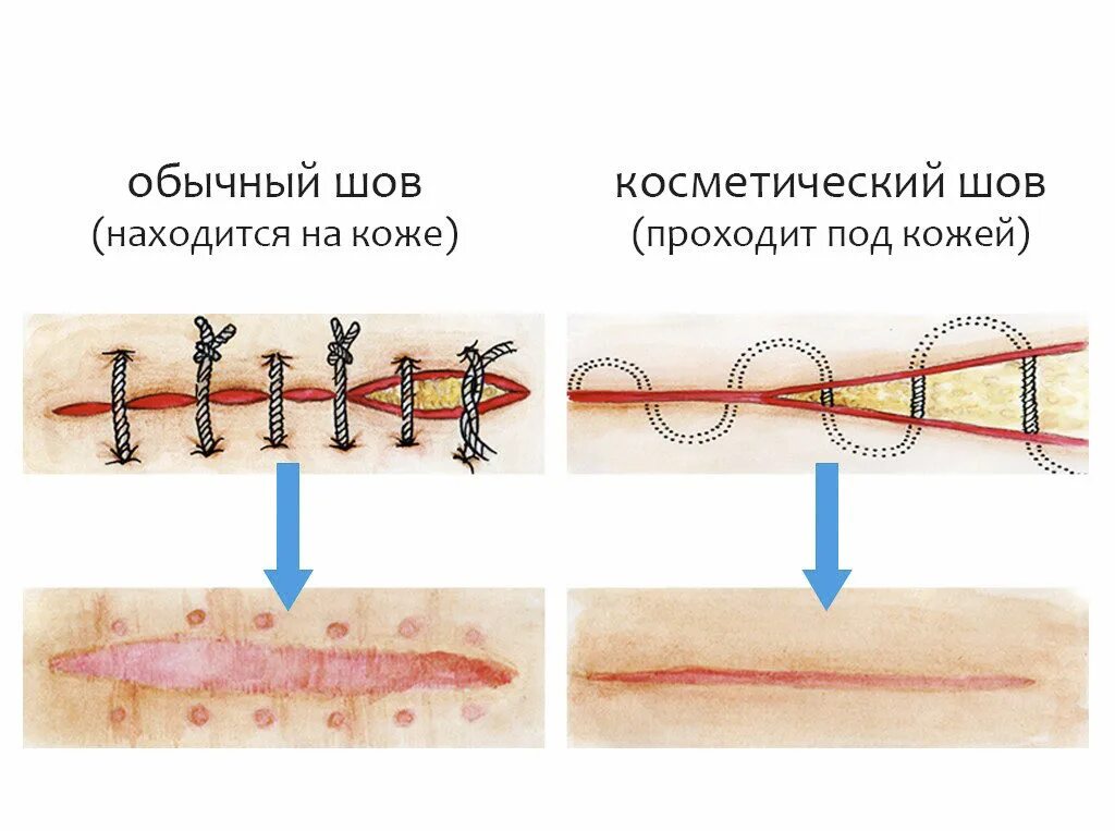 Шов хирургический внутрикожный. Косметический шов кесарева скобы. Косметический шов после операции КС. Косметический шов отличие от хирургического.