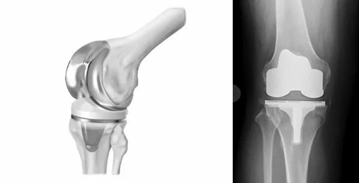 Асептический некроз мыщелка. Тотальное эндопротезирование коленного сустава DEPUY. Эндопротезирование мыщелка большеберцовой кости. Эндопротез коленного сустава Депью Сигма. Асептический некроз коленного сустава.