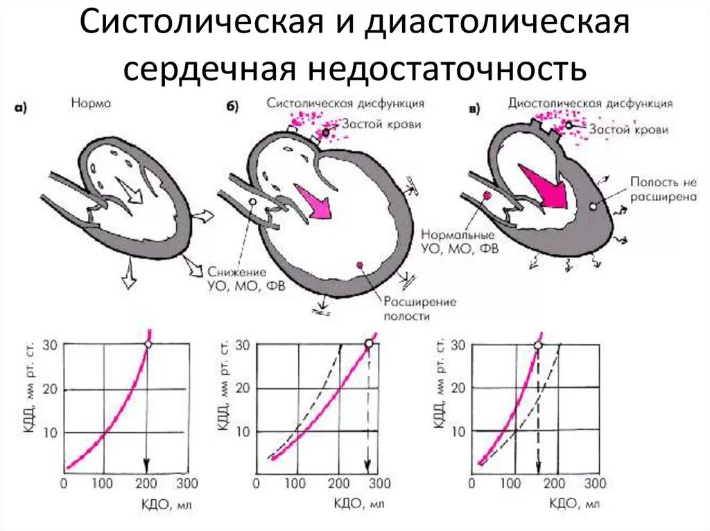 Дисфункции желудочков сердца. Систолическая недостаточность левого желудочка. Систолическая дисфункция левого желудочка на ЭХОКГ. Систолическая функция миокарда лж. Диастолическая сердечная недостаточность левого желудочка.