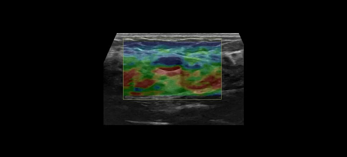 Эластография щитовидной железы что это. Компрессионная эластография. Компрессионная эластография молочных желез. Эластография щитовидной. УЗИ молочных желез эластография.