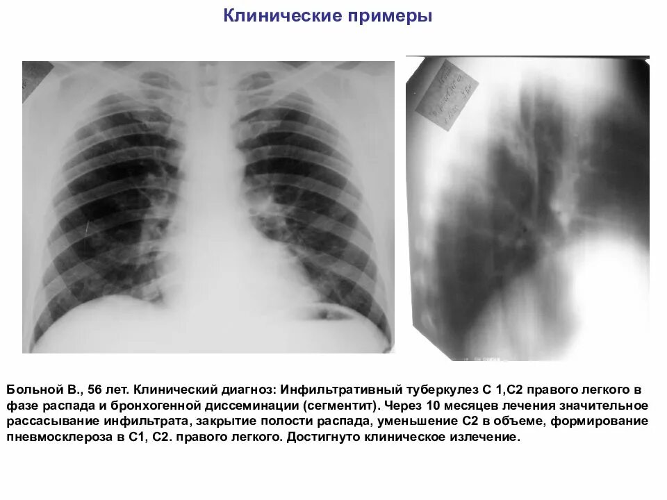 Инфильтративный легкого в фазе распада. Инфильтративный туберкулез диагноз. Инфильтративный туберкулез правого легкого в фазе инфильтрации. Инфильтративный туберкулез s6. Инфильтративный туберкулез рентгенограмма.