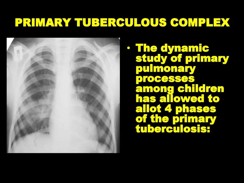 Bovis, m. Бактерия mycobacterium tuberculosis. Микобактерия туберкулеза анаэроб. Tuberculosis complex. Бактерии вызывающие туберкулез.