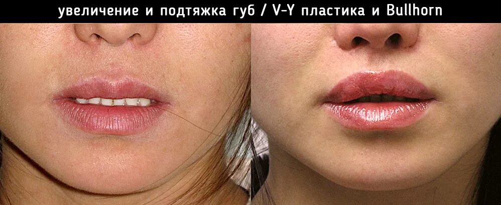 Оперированные губы. Хейлопластика кессельринг. пластика губ кессельринг. операция губы кессельринг. хейлопластика кессельринг до и после.