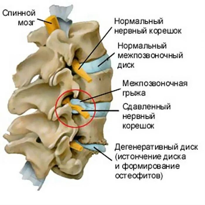 Анатомия нервных Корешков поясничного отдела позвоночника. Схема поясничного отдела позвоночника с дисками. Защемление Корешков позвоночника. Грыжа шейного отдела позвоночника анатомия.