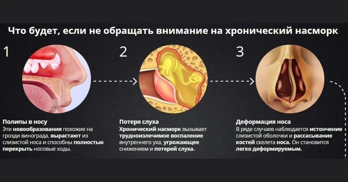 Почему сильные сопли. Носовые раковины при аллергическом рините. Хронический насморк причины.