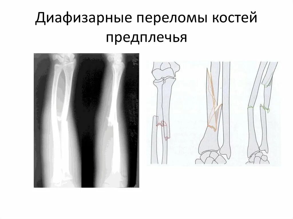 Диагноз перелома лучевой кости. Перелом диафиза обеих костей предплечья. Перелом средней трети локтевой кости. Перелом диафиза лучевой кости рентген. Перелом диафиза локтевой кости рентген.