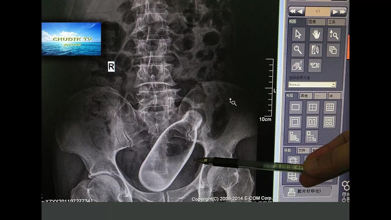 Инородное тело в кишечнике. Инородные предметы в прямой кишке. Инородные тела прямой кишки. Инородные из прямой кишки. Инородные предметы в прямой кишке рентген.