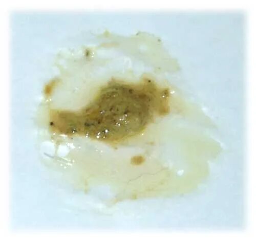 Слюни желтого цвета. Слюни желтого цвета. Гонококковый цервицит. Мокрота с кровяными прожилками. Цвет слизисто-гнойной мокроты.