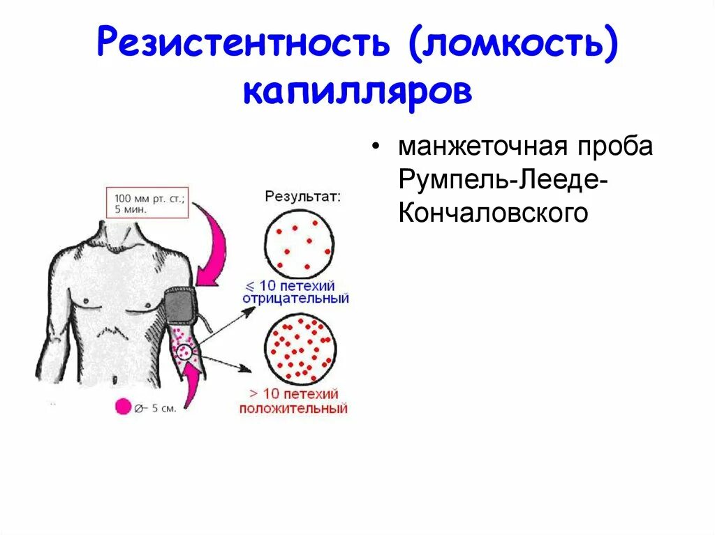 Проба на резистентность капилляров. Пробы на механическую устойчивость капилляров. Проба румпеля Лееде Кончаловского. Положительная манжеточная проба.