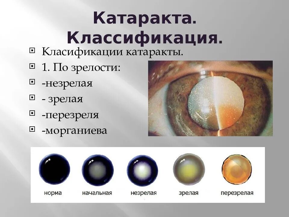 Катаракта глаза симптомы и лечение. Гипокальциемическая катаракта. тип наследования катаракты. тетаническая катаракта. периферическая катаракта.