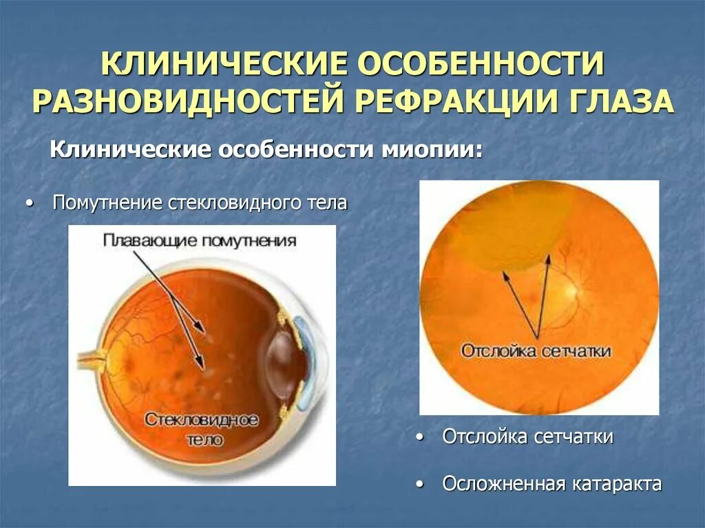 Субъективный метод определения рефракции. Клиническая рефракция глаза. виды клинической рефракции. рефракция классификация.