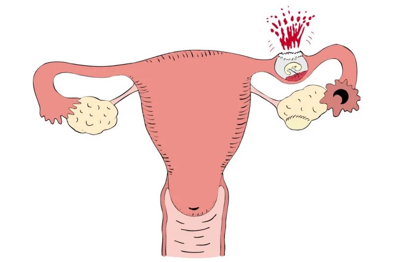 Удаление матки будут ли месячные. Внематочная беременность разрыв маточной трубы. Внематочная беременность трубный разрыв. Внематочная (эктопическая) беременность. Патоморфология внематочной беременности.