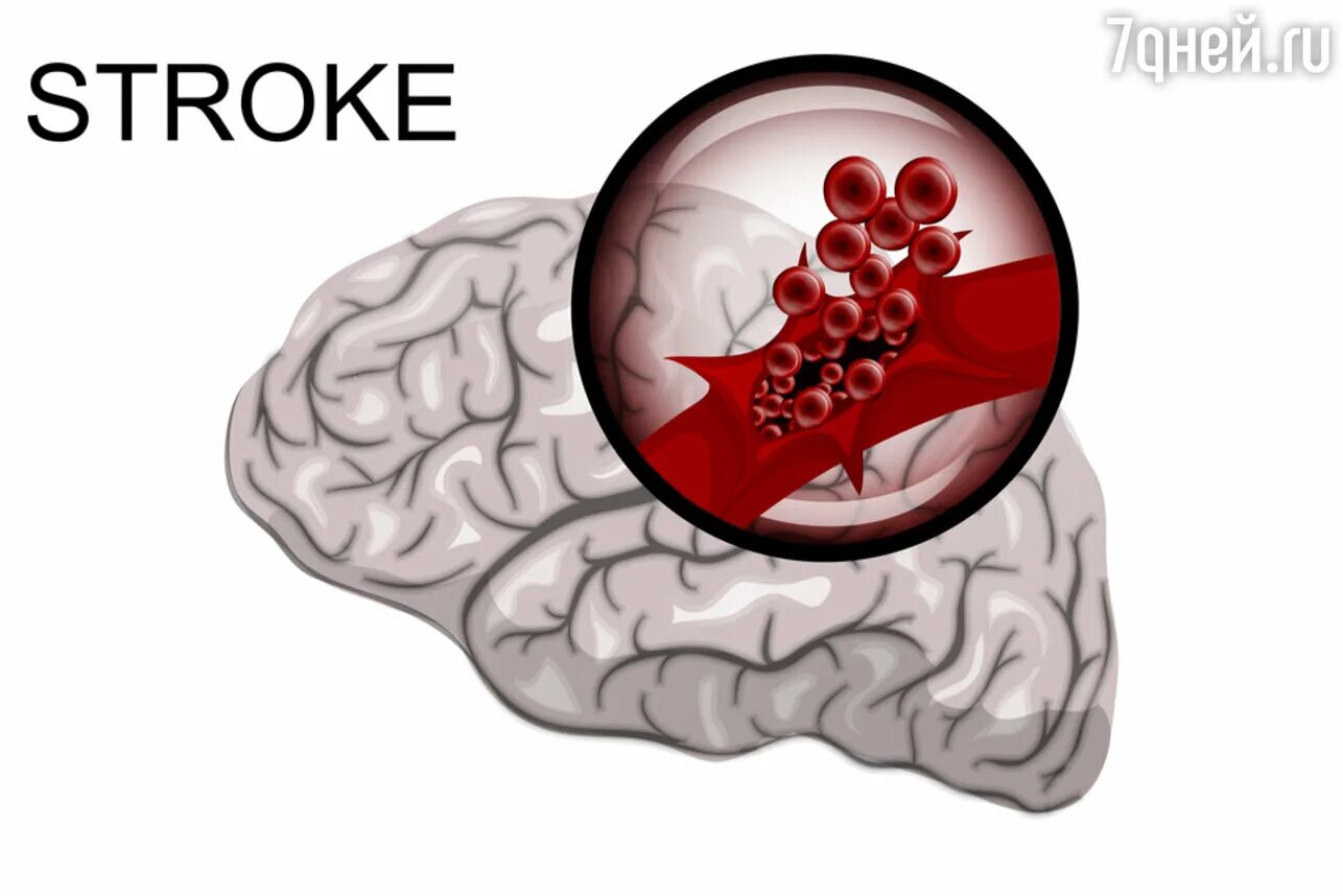ОНМК геморрагический инсульт. Инсульт рисунок. Геморрагический инсульт картинки. Кровоизлияние в головной мозг. Мозг без крови