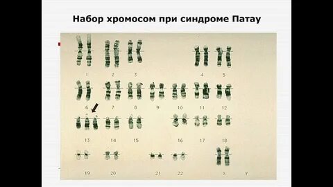 Кариотип 13