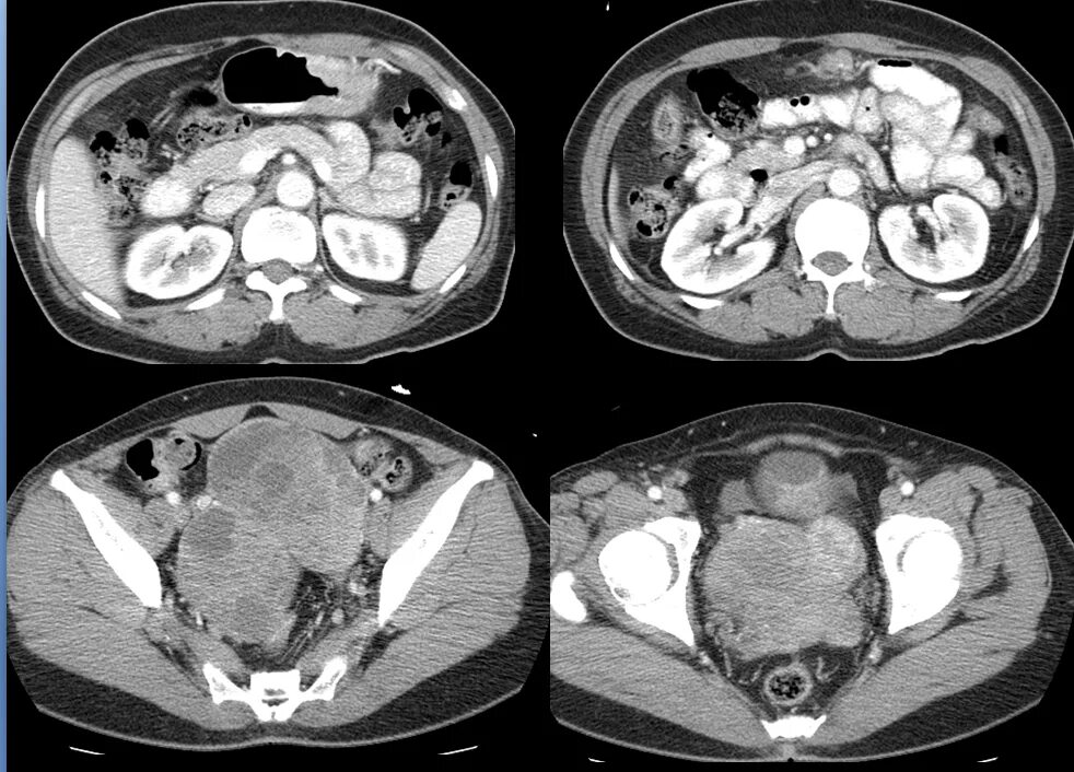 Рак яичника мрт. Опухоль Крукенберга мрт. Метастазы Крукенберга мрт. Метастаз Крукенберга кт. Опухоль Крукенберга яичника.