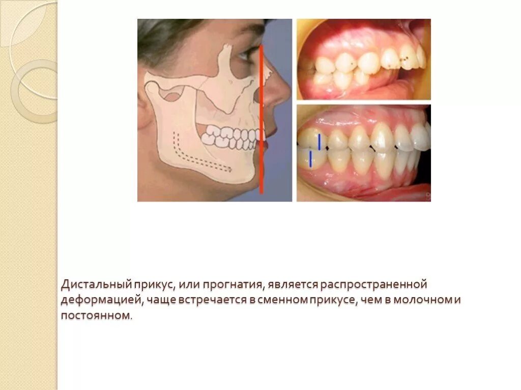 глубокий дистальный прикус профиль. неправильный прикус прогения. верхние зубы вперед нижних. мезиальный прикус челюсть. верхние зубы вперед нижних.