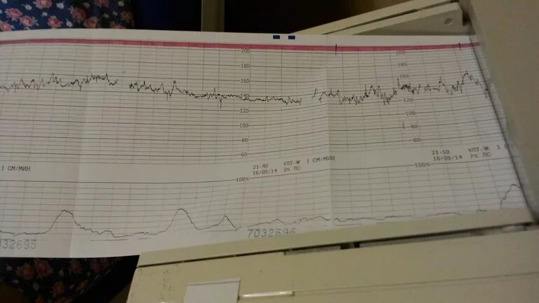Схватки на 32. КТГ при начале родовой деятельности. Тонус на КТГ. Начальные схватки на КТГ. КТГ при тренировочных схватках.