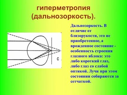 Гиперметропия слабой степени код
