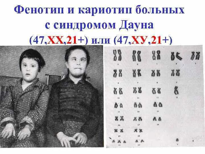 Фенотип ребенка с синдромом дауна. Фенотип ребенка с синдромом дауна. Синдром дауна симптомы и признаки. Фенотип ребенка с синдромом дауна. Клинические проявления болезни дауна.