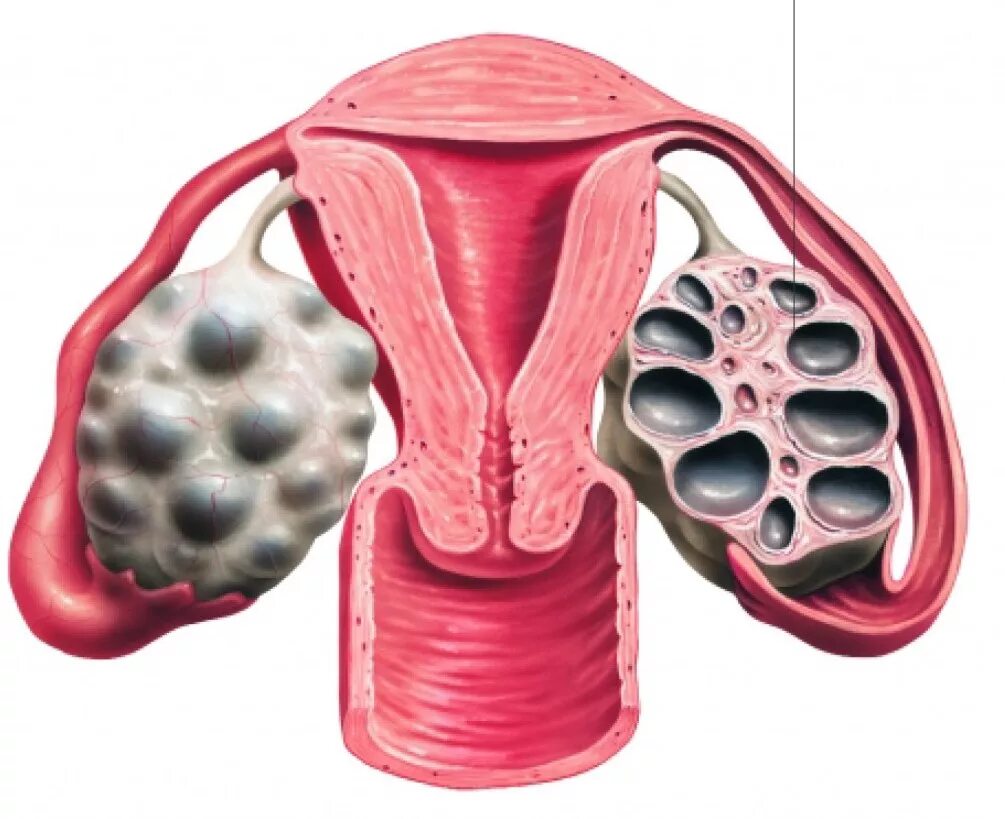 ПКЯ – поликистозные яичники. Поликистоз яичников (СПКЯ). Мультикистоз яичников. Что значит изменение яичников