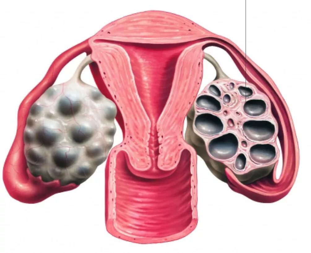 Поликистозные яичники лечение. ПКЯ – поликистозные яичники. Поликистоз яичников (СПКЯ). Мультикистоз яичников.
