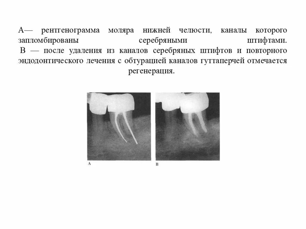 Пломбировка корневых каналов. Пломбировка гуттаперчевыми штифтами. Штифт для обтурации корневого канала. Серебряные штифты для пломбирования каналов. Серебряные штифты в стоматологии для пломбирования корневых каналов.