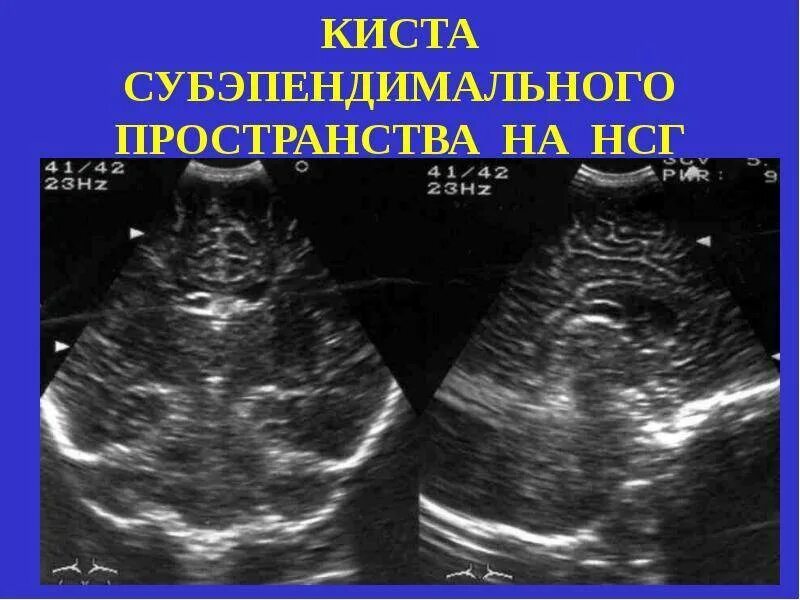 У плода киста мозга сплетения. Субэпиндемальная киста НСГ. Суб эпендималний киста. Субэпендимальная киста на УЗИ. УЗИ нейросонография новорожденных.