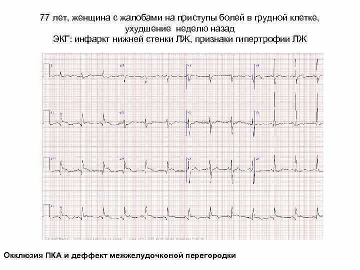 Изменение миокарда передне перегородочной области. Инфаркт межжелудочковой перегородки ЭКГ. Гипертрофия межжелудочковой перегородк на ЭКГ. Гипертрофия межжелудочковой перегородки на ЭКГ. ЭКГ рубцовые изменения передне-перегородочной.