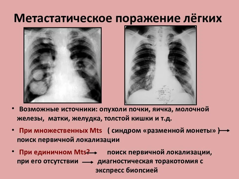 Диагноз d 38.1. Метастатическое поражение легких рентген. Поражение легких при коронавирусе. Метастатические опухоли легких.